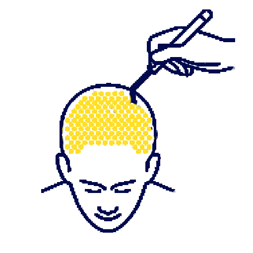Dubai Hair Transplant